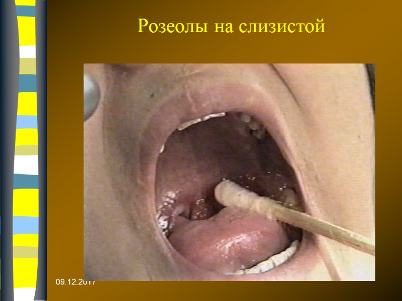 09.12.2017 Розеолы на слизистой